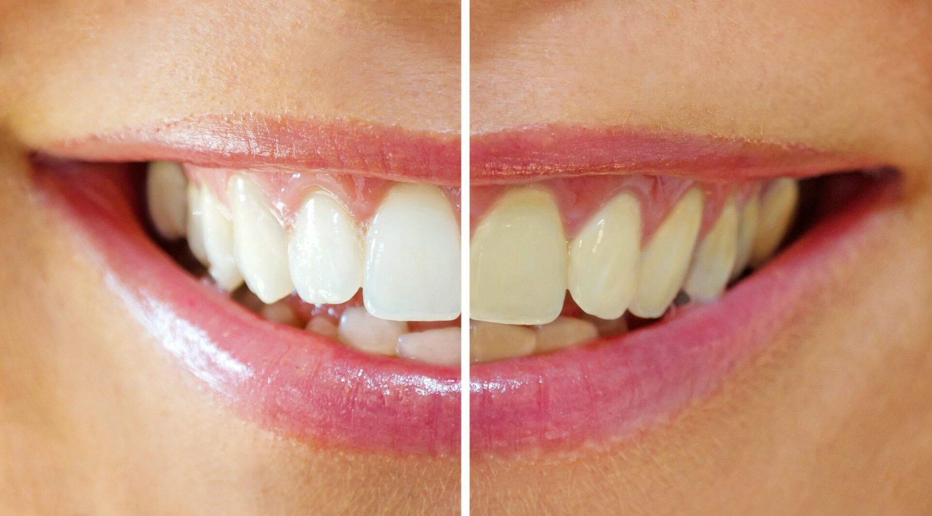 Teeth (before and after)