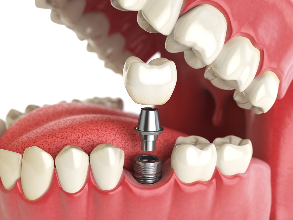 dental-implants-1024x768