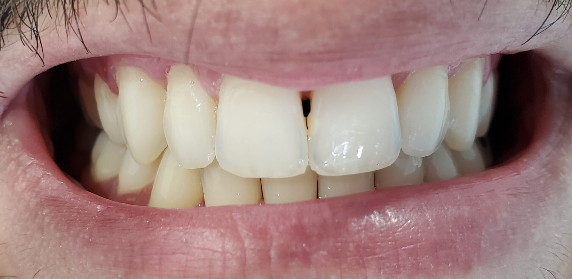 Andrew whitening after